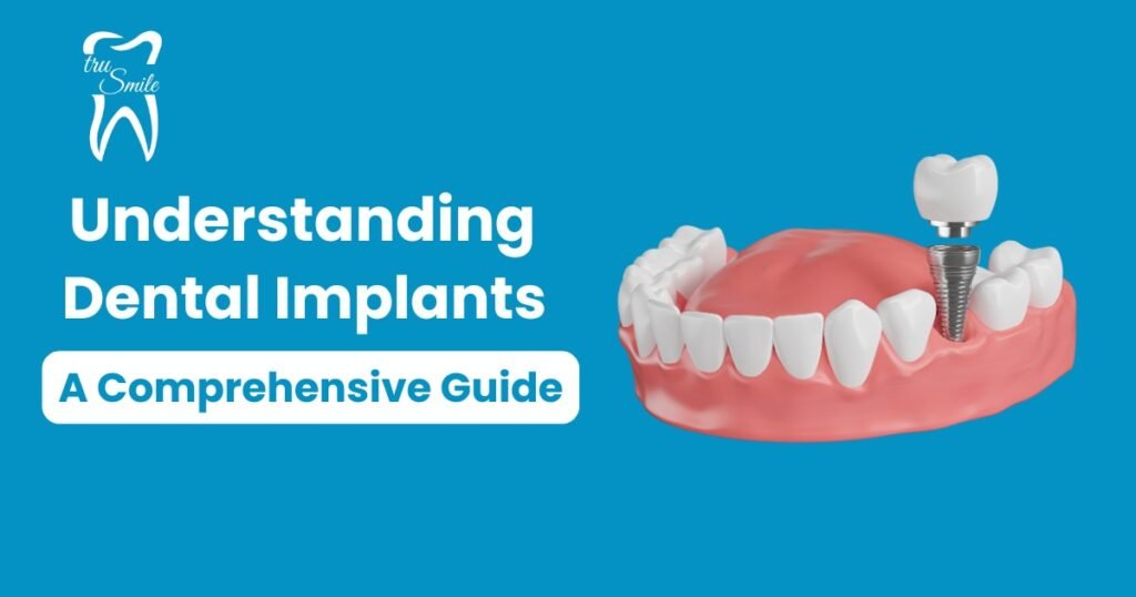 This image show the structure of dental implant and the bold text Undestand dental impants in white color and A comprehensive guide with white background.