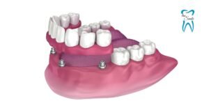 Detailed diagram of All-on-4 dental implants, showing four titanium posts anchored in the jawbone supporting a full arch of artificial teeth for complete mouth restoration.