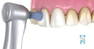 Dental professional using an ultrasonic scaler to remove plaque from a patient's teeth, highlighting the importance of oral hygiene and regular dental checkups.