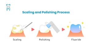 Illustration of the scaling and polishing process for teeth. Steps include scaling to remove plaque, polishing to smooth the surface, and applying fluoride for protection.