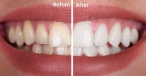 "Alt text: A close-up image showing a comparison of teeth before and after whitening. The left side labeled 'Before' shows yellowish teeth, while the right side labeled 'After' shows whiter teeth.