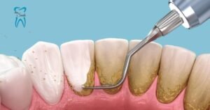 "Alt text: Illustration of dental scaling procedure showing a dental tool removing plaque and tartar buildup from teeth, with a logo of 'tru Smile' in the top left corner.