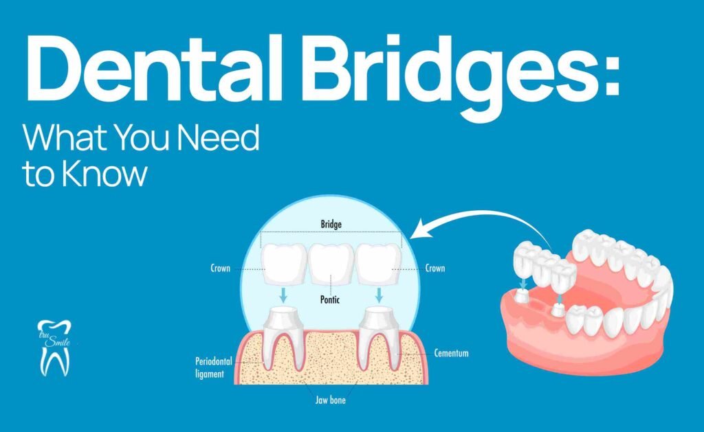 Diagram showing dental bridges: crowns, pontic, periodontal ligament, cementum, and jaw bone. Illustrates how a bridge fits in the mouth for dental health.