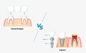 Illustration comparing dental bridges and implants. Bridges: three crowns supported by nearby teeth. Implants: crown, abutment, and screw in jawbone. Shows restoration options.