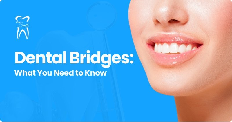 Informational graphic with a blue background titled 'Dental Bridge: What You Need to Know' and a 'Pure Smile' logo with a tooth icon in the top left corner.