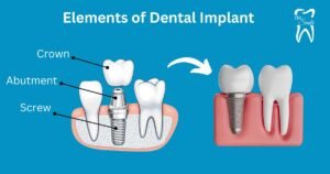 Cerulean blue background with labeled dental implant diagram, showing crown, abutment, and screw, with arrow indicating post-treatment natural tooth appearance.