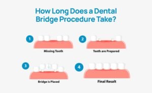 Illustration showing the steps of a dental bridge procedure: 1. Missing tooth, 2. Teeth are prepared, 3. Bridge is placed, 4. Final result.