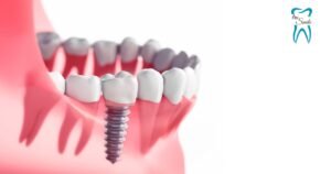 This image show the nature look of teeth after the Dental Implant.