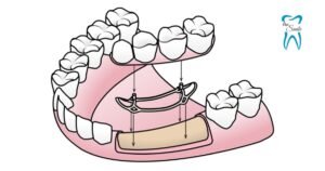 This Animated Image showing the structure of a subperiosteal implant in the jawbone.