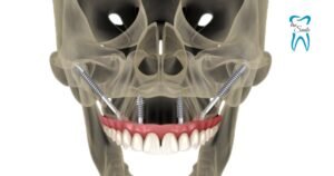 This Animated Image showing the structure of a Zygomatic Implants in the jawbone.